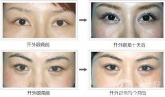 開眼角增生多久恢復?開眼角增生恢復時間？