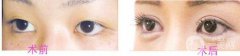 開眼角留疤痕怎么辦？開眼角會留疤嗎？