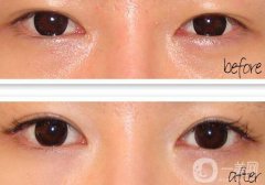 開眼角疼嗎？開眼角痛不痛？