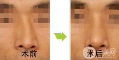 歪鼻矯正一般多少錢？歪鼻矯正手術(shù)價格詳細解析