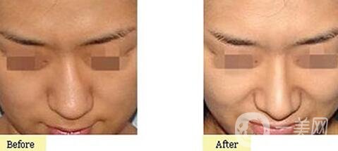 歪鼻矯正一般多少錢？歪鼻矯正手術價格詳細解析