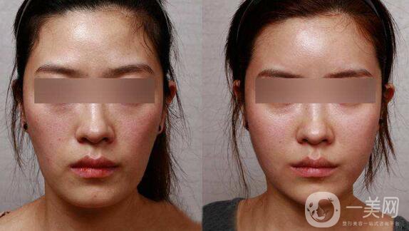 北京朝陽醫(yī)院范巨峰做面部自體脂肪填充怎么樣