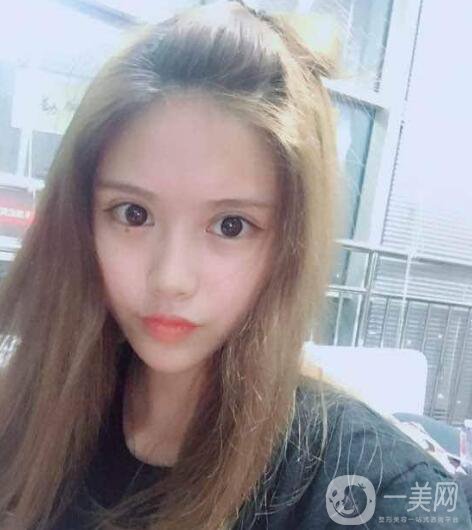 成都開眼角價位是多少 開眼角需要花費(fèi)多少錢