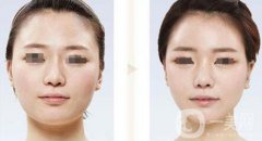 臉部削骨手術多少錢？削骨瘦臉價格詳解