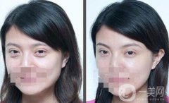 北京去眼袋手術多少錢？去眼袋價格詳細解析