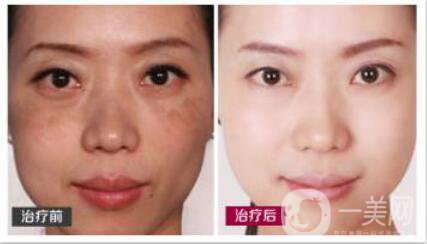 激光調(diào)節(jié)黃褐斑要多少錢？激光祛黃褐斑價(jià)格價(jià)格分析