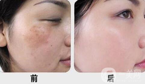 激光調(diào)節(jié)黃褐斑要多少錢？激光祛黃褐斑價(jià)格價(jià)格分析