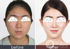 光子嫩膚果怎么樣？光子嫩膚多長時間做一次？