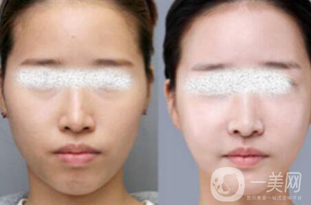 光子嫩膚*果怎么樣？光子嫩膚多長時間做一次？