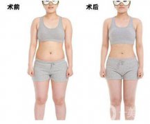 超聲波吸脂減肥果怎么樣？超聲波吸脂減肥多少錢？　　