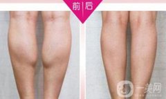 注射瘦腿果好嗎？注射瘦腿多少錢一針？