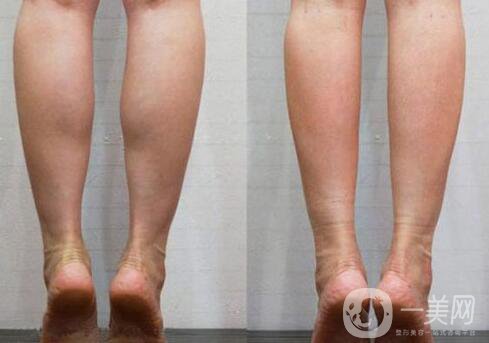 **果好嗎？*多少錢一針？