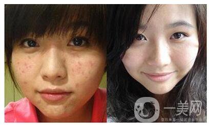 廣州e光祛痘價(jià)格貴不貴？多少錢？