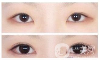 北京開眼角費(fèi)用需要多少錢