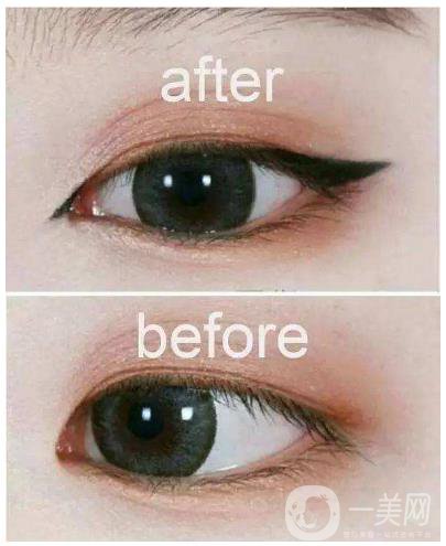 開眼角手術(shù)過程 開眼角前后照片圖