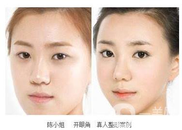 開眼角手術(shù)過程 開眼角前后照片圖