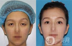 上瞼下垂矯治術(shù)多少錢？詳細(xì)價格盤點~