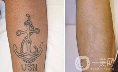 醫(yī)院洗紋身價格 收費(fèi)明細(xì)詳解