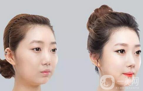 咬肌切除手術(shù)多少錢？切除咬肌價(jià)格收費(fèi)明細(xì)~