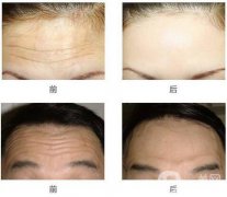 抬頭紋怎么去？去抬頭紋的方法？