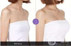 妙桃假體隆胸多少錢 收費明細(xì)詳解