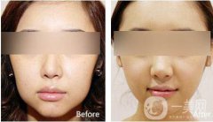 改臉型要多少錢？改臉型價格是多少？