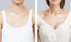 妙桃假體隆胸多少錢(qián)？妙桃假體隆胸價(jià)格？