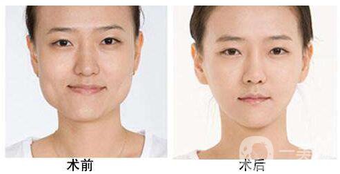 削骨手術(shù)危險(xiǎn)嗎 怎樣降低手術(shù)危險(xiǎn)