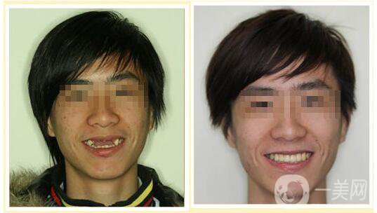 種植牙的利與弊 種植牙的優(yōu)勢(shì)缺點(diǎn)分析