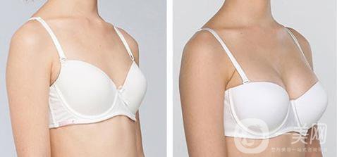 隆胸材料有哪些牌子？有哪些優(yōu)缺點？