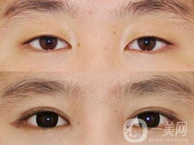 高分子雙眼皮是*嗎?高分子雙眼皮適合哪些人？