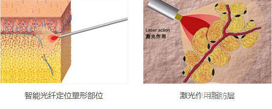 光纖溶脂減肥*果嗎?有哪些注意事項(xiàng)？