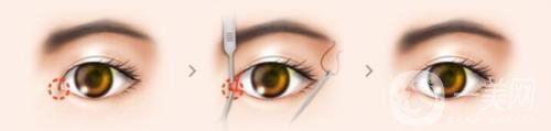 開眼角有危險(xiǎn)嗎？有些什么后遺癥？