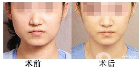 咬肌發(fā)達怎么辦 怎么瘦臉部咬肌*