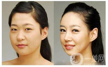 北京整形醫(yī)院做磨骨多少錢