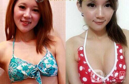 北京隆胸介紹 北京隆胸哪家醫(yī)院比較好