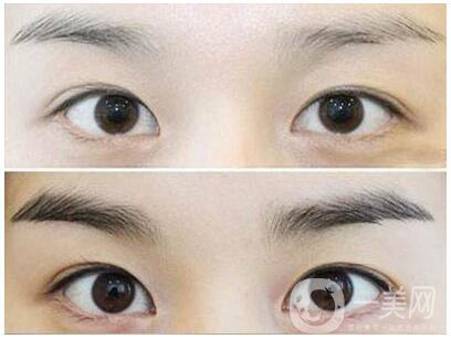 南京繡眉價格是多少 費用分析