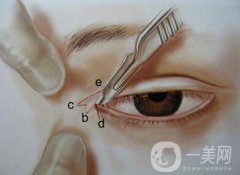 開眼角有風險嗎？開眼角風險有哪些？