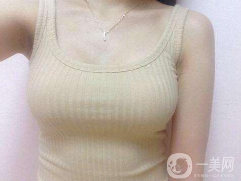 娜高假體隆胸多少錢(qián)？收費(fèi)情況說(shuō)明~