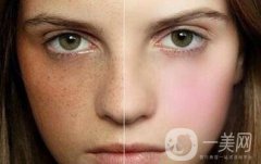 激光祛斑多少錢？激光祛斑價格是多少？