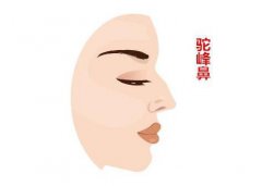 駝峰鼻矯正方法？如何矯正駝峰鼻