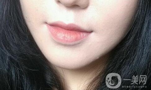 墊下巴后多久可以按摩 術(shù)后如何護(hù)理