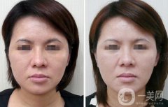 光子嫩膚大概要多少錢？光子嫩膚價(jià)格詳解