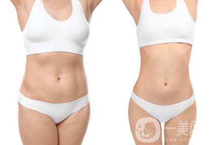 南京吸脂減肥價格是多少？收費明細~