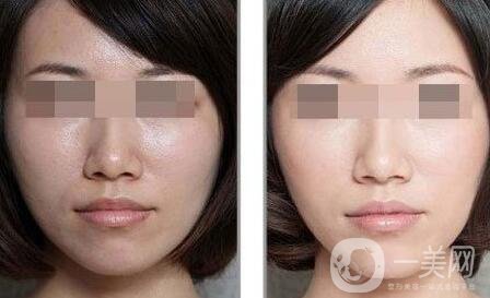 彩光嫩膚要多少錢？彩光嫩膚價格需要多少？