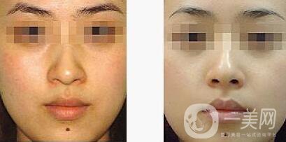 光子嫩膚適合人群有哪些？光子嫩膚不適合哪些人？