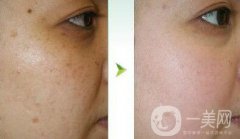 光子嫩膚調(diào)節(jié)黃褐斑果怎么樣？去黃褐斑圖