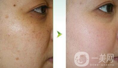 光子嫩膚調(diào)節(jié)黃褐斑*果怎么樣？去黃褐斑圖