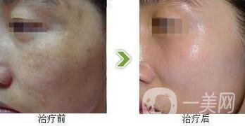 光子嫩膚調(diào)節(jié)黃褐斑*果怎么樣？去黃褐斑圖