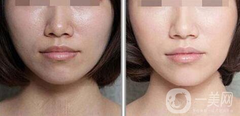 光子嫩膚如何護(hù)理？光子嫩膚的注意事項(xiàng)